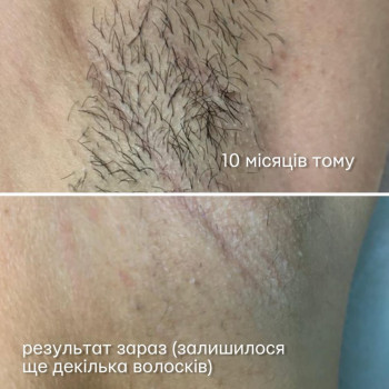 Фото з портфоліо майстра Аліна Юнчик (майстер епіляції, Хмельницький)