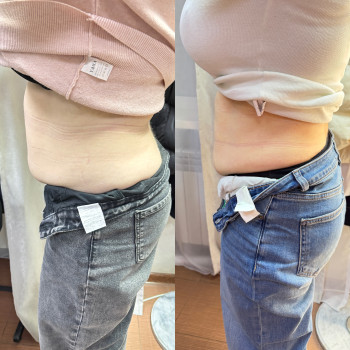 Три инъекции биопатида, фото - косметолог-инъекционист Любов Чумаченко