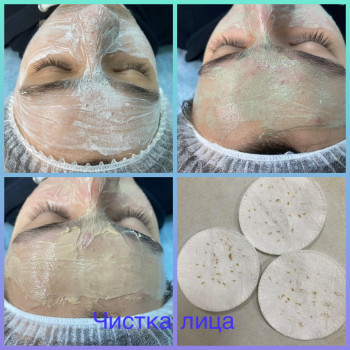 Комбінована чистка обличчя, фото - майстер з пірсингу Тетяна Ананьєва