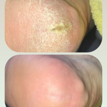 Не терпи боли и дискомфорт. Пяточки без трещин – это уверенность в каждом шаге. Подологический кабинет по адресу ул. Победы 3-А!!! Я знаю, как помочь., фото - подолог Ірина Абраменко