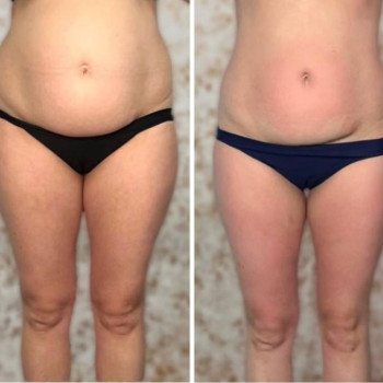 кріоліполіз