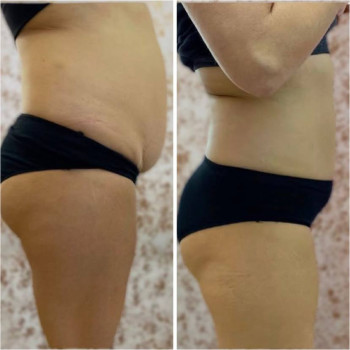 кріоліполіз