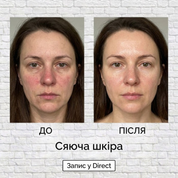 Косметологічна процедура Гідропілінг та led маска