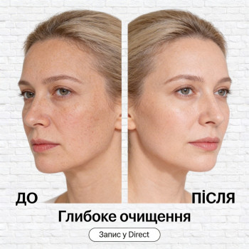 Косметологічна процедура Гідропілінг та led маска