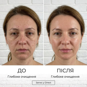 Косметологічна процедура Гідропілінг та led маска