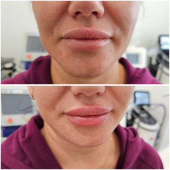 Збільшення губ