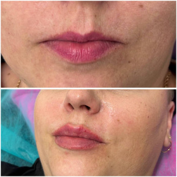 Збільшення губ