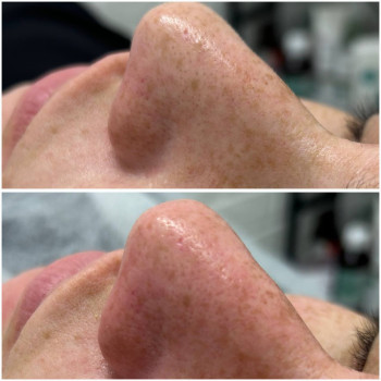 Косметологічна чистка обличчя