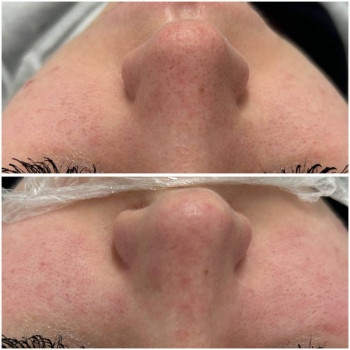 Косметологічна чистка обличчя