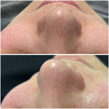 Косметологічна чистка обличчя