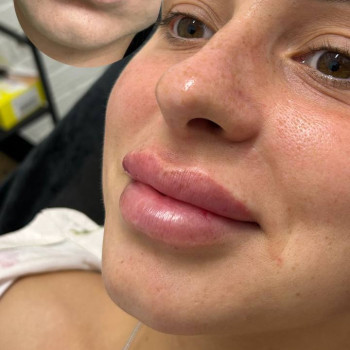 Корекція губ
