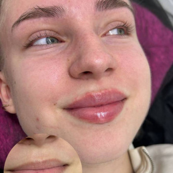 Корекція губ