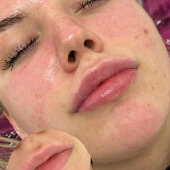 Корекція Губ