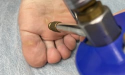 Удаление бородавок , папиллом , кератом , стержневых мозолей и др. новообразований жидким азотом Майстер з пірсингу Татьяна Київ