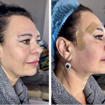 Нитковий ліфтинг Cog