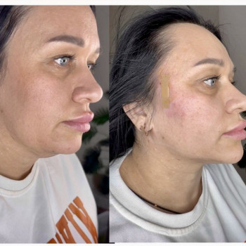 Нитковий ліфтинг Cog