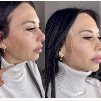 Нитковий ліфтинг Cog