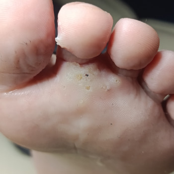 Перший візит. Множинні