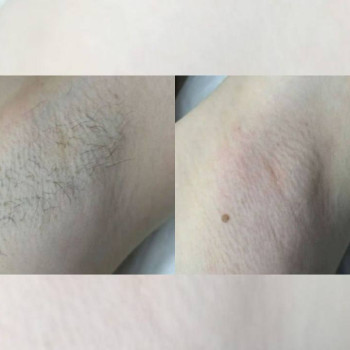 Результат електроепіляції пахв у студії на Святошині, Київ: зліва — до процедури, справа — після. Видно чисту шкіру без волосся, акуратну роботу та рівномірний результат.