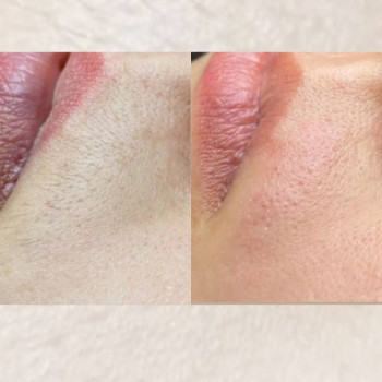 Електроепіляція волосся над верхньою губою: результат до та після процедури у студії в Києві.