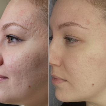 БІОРЕВІТАЛІЗАЦІЯ ОБЛИЧЧЯ - ЩО ЦЕ ТАКЕ? ⠀ Назва терапії перекладається як «природне пожвавлення». ⠀ Гіалурон важливий для шкіри. Він сприяє зв'язування вологи, що позитивно позначається на стані дерми. Але з роками цієї речовини не вистачає в організмі. Біоревіталізація – це корекція косметичних недоліків шкіри шляхом насичення її глибоких шарів гіалуроновою кислотою. ⠀ ЯКОГО ЕФЕКТУ ВАРТО ЧЕКАТИ: ▫️шкіра зволожується, оздоровлюється, отримує важливі поживні речовини; покра