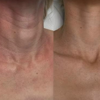 З обличчям все зрозуміло, але як же шия? Дорогі пані, ми з вами любимо доглядати за обличчям і часто забуваємо про шию 🤔 Адже саме ця частина тіла видає наш вік найсильніше 🥲 З усіх anti-age процедур зоні шиї та декольте у кращому випадку дістаються залишки нічного крему для обличчя, а то й зовсім нічого. Але якщо завзято ігнорувати потреби шкіри цих делікатних областей, можна отримати дивний (а часом і страшний) неприродний ефект молодого обличчя на в'ялій шиї 😩 Шкіра шиї та де