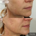 Біоревіталізація обличчя Масажист Мария Київ