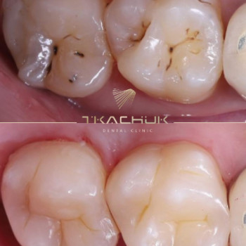 Фото с портфолио Тkachuk Dental