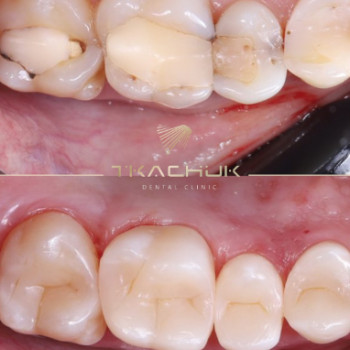 Фото с портфолио Тkachuk Dental