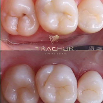 Фото с портфолио Тkachuk Dental