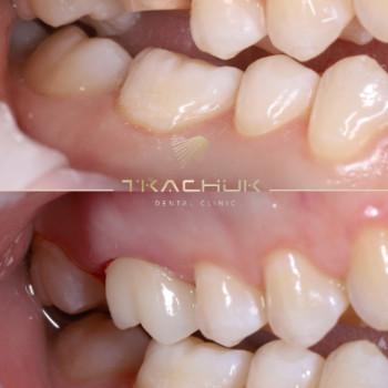 Фото с портфолио Тkachuk Dental