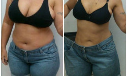 Инъекции для похудения Mounjaro Косметолог-инъекционист Любов Запорожье