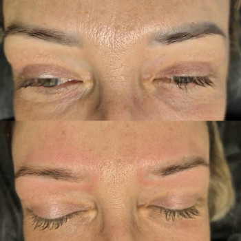 Видалення лазером. Один сеанс