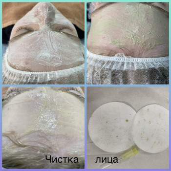 Чистка обличчя комбінована