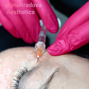 Ін'єкційна біоревіталізація (біорепарація) орбітальної зони