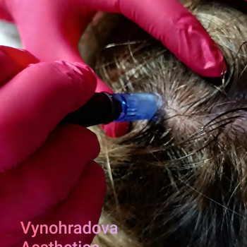 Фракційна мезотерапія (мікронідлінг) волосистої частини голови. Стимуляція росту волосся, оздоровлення і, зволоження і живлення шкіри голови, зупинка випадіння волосся.