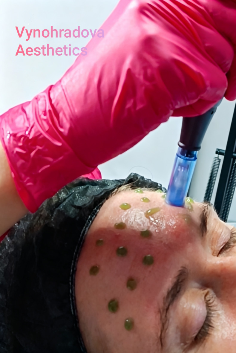 Мікронідлінг (фракційна мезотерапія) обличчя. Стимуляція вироблення власного колагену, оновлення шкіри, живлення, зволоження. Усунення дрібних зморшок, рубців постакне, освітлення пігментації, фото - Косметолог Лілія Виноградова