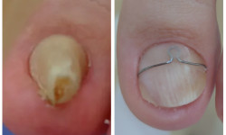 Корегуюча система Скоба Фрезера Подолог Ірина Київ