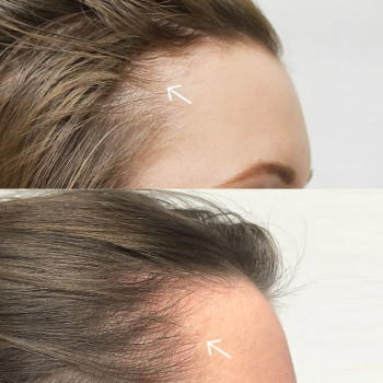 Озонотерапія