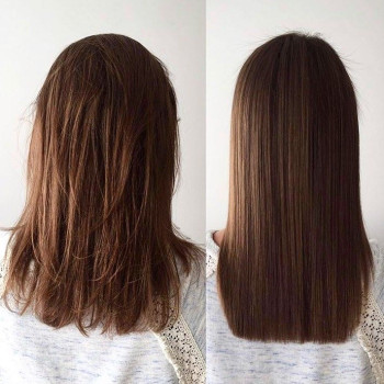 Озонотерапія