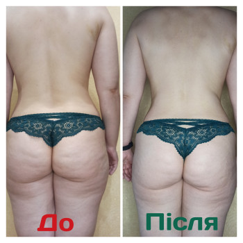 Після одного сеансу видно помітне покращення: рельєф шкіри став більш рівним, прояви целюліту зменшилися, шкіра виглядає більш підтягнутою та гладкою. Також трохи вирівнявся тон і зменшилась «пухкість» у зоні сідниць і стегон.✨
