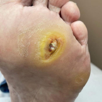 Обробка діабетичної стопи ДО/