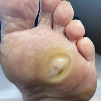 Обробка діабетичної стопи ПІСЛЯ/