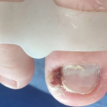 Врослий ніготь ДО/