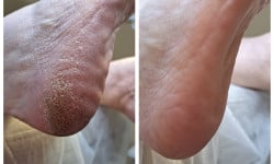 Подологический педикюр Подолог Оксана Харьков