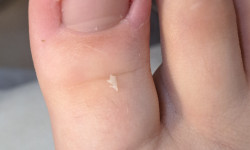 Вросшие ногти Подолог Оксана Харьков