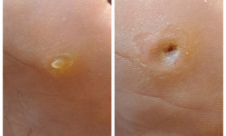 Удаление мозолей Подолог Оксана Харьков