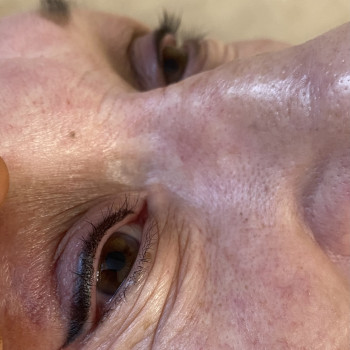 Стрелка на возрастной коже.