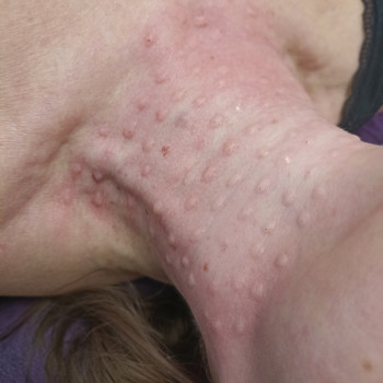 Біоревіталізація шиї препаратом Jalupro