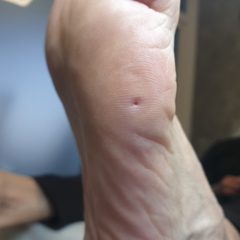 Удаление стрежневой мозоли